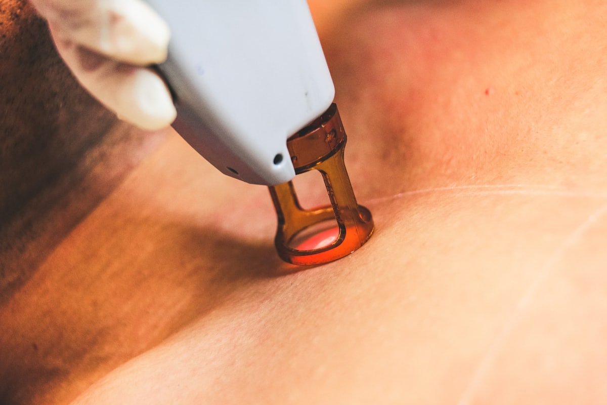 Sessão de depilação a laser na clínica